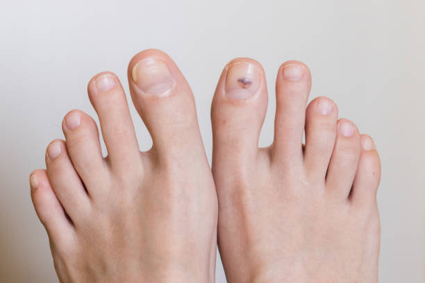 Toenail Fungus & Foot Care
